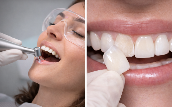 Risultato prima dopo faccette dentali