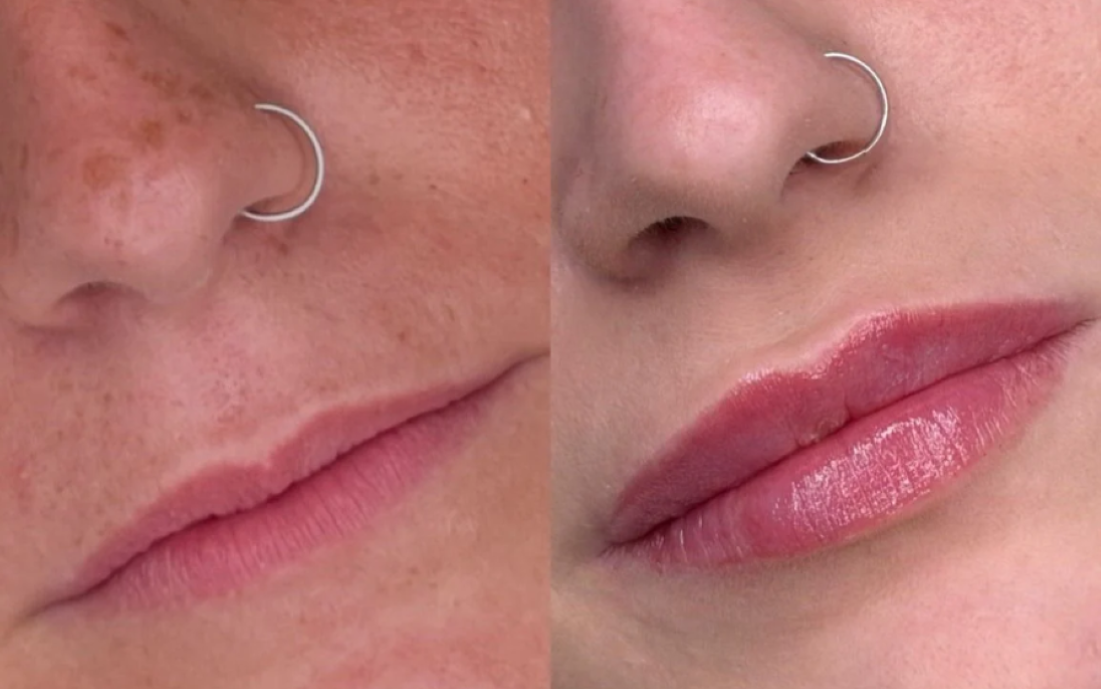 Risultato prima dopo filler labbra da Eridentimed