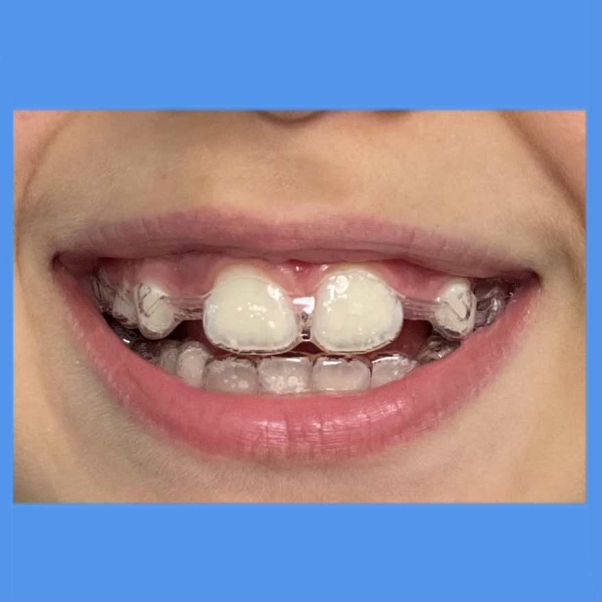 Ortognatodonzia - Orthodontist - Blog Category